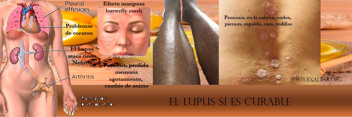 Remedio lupus curacion eduardosandoval